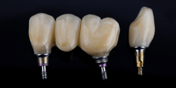 types of teeth implants