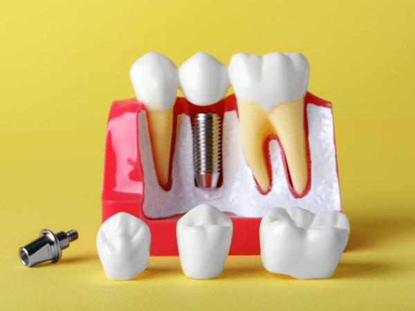 types of teeth implants